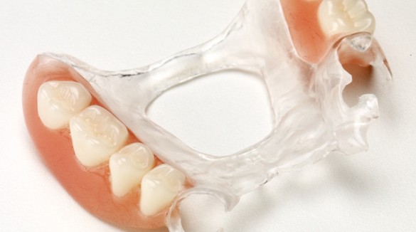 Почему съемные зубные протезы могут быть предпочтительней имплантов
